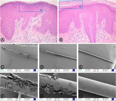 A novel mutation in SPINK5 gene underlies a case of atypical Netherton syndrome